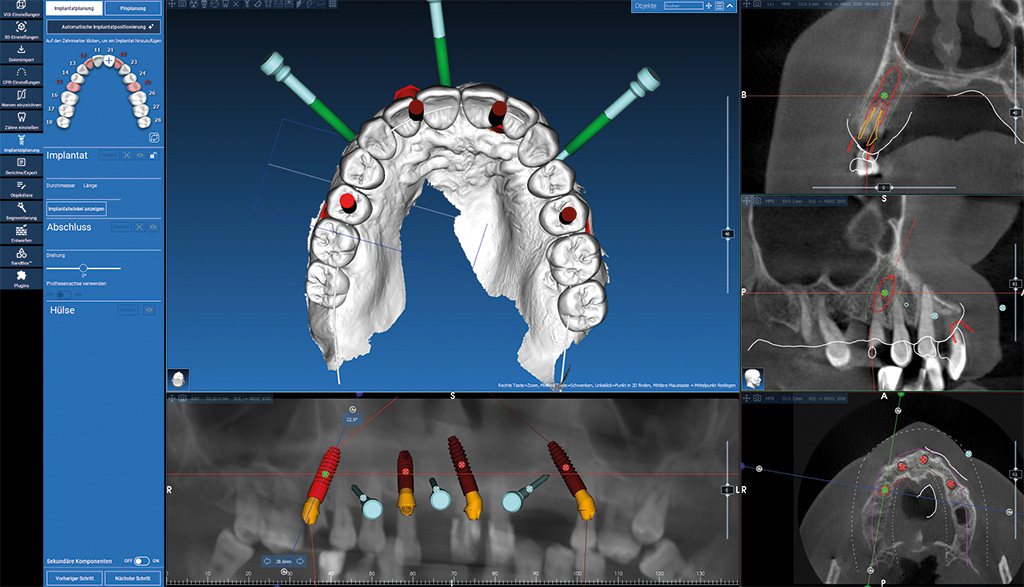 3-Implantat-Planung-